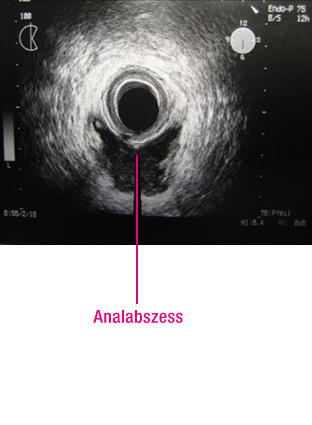 Rektale Sonographie Ultraschall
